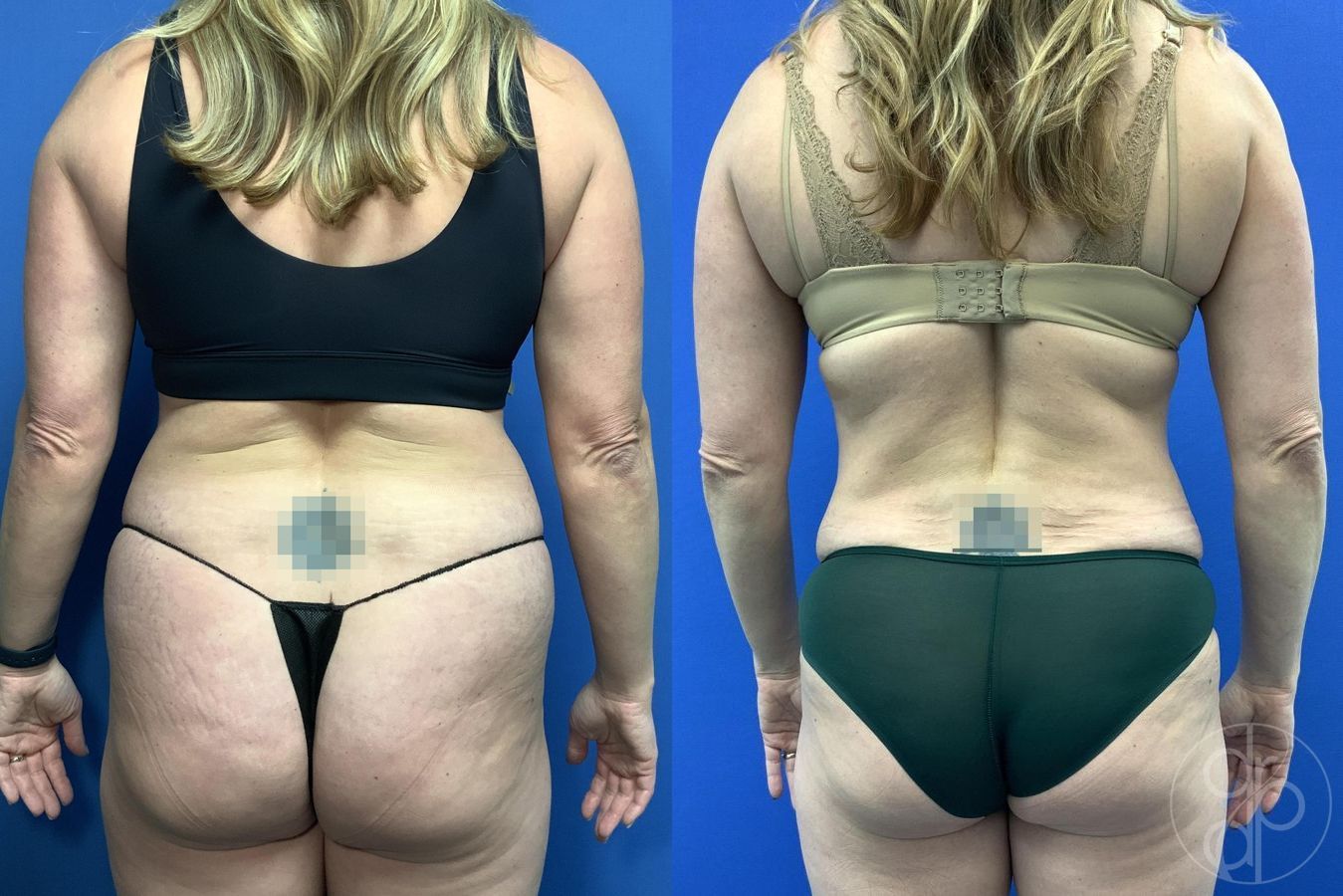 Before and after Liposuction case 30000 - Angle 2
