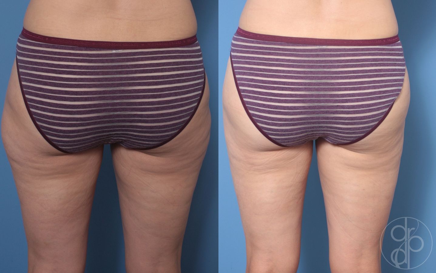 Liposuction - Thumbnail 4