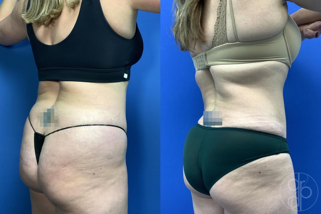 Before and after Liposuction case 30000 - Angle 3