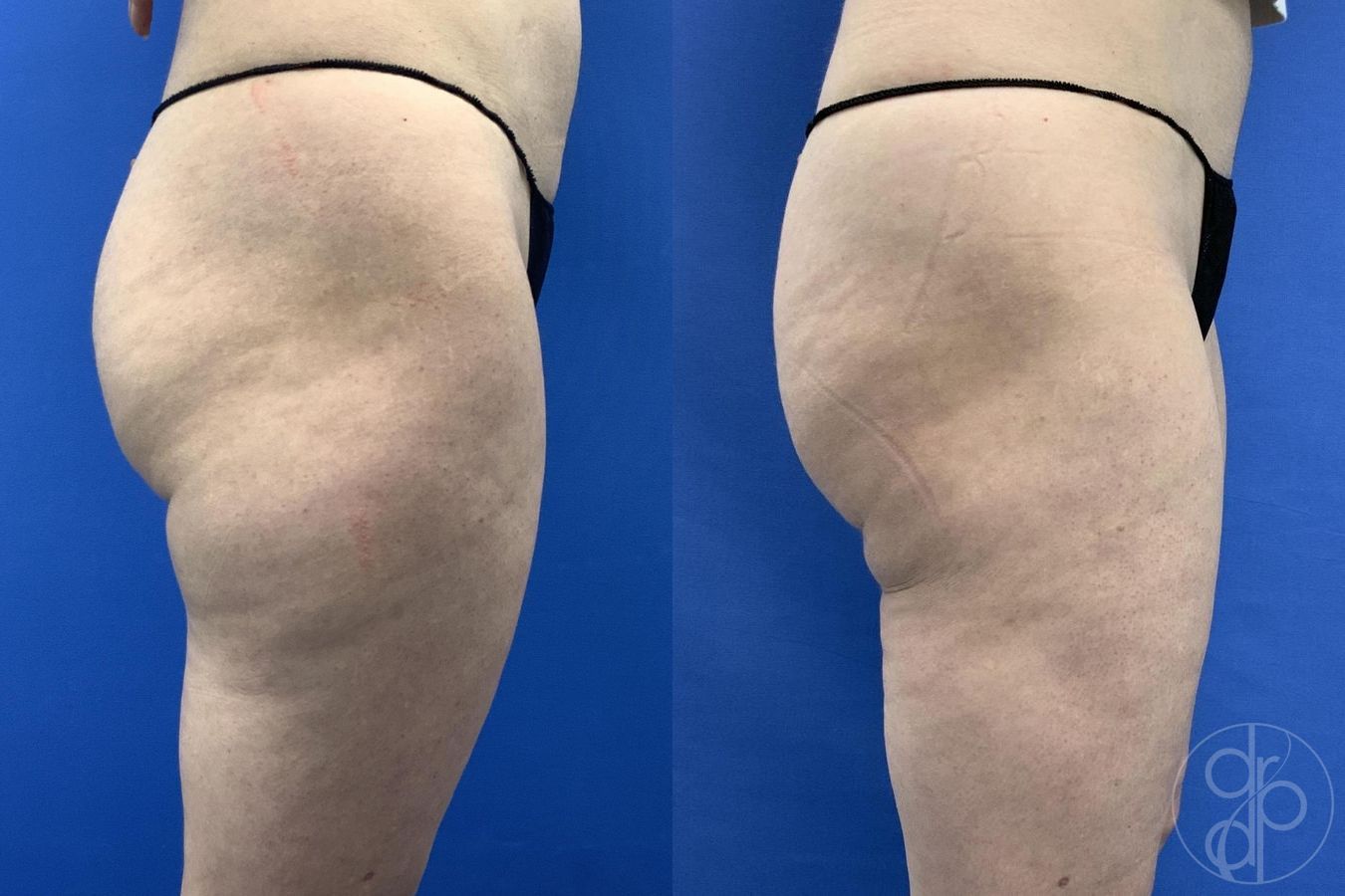 Before and after Liposuction case 30021 - Angle 7