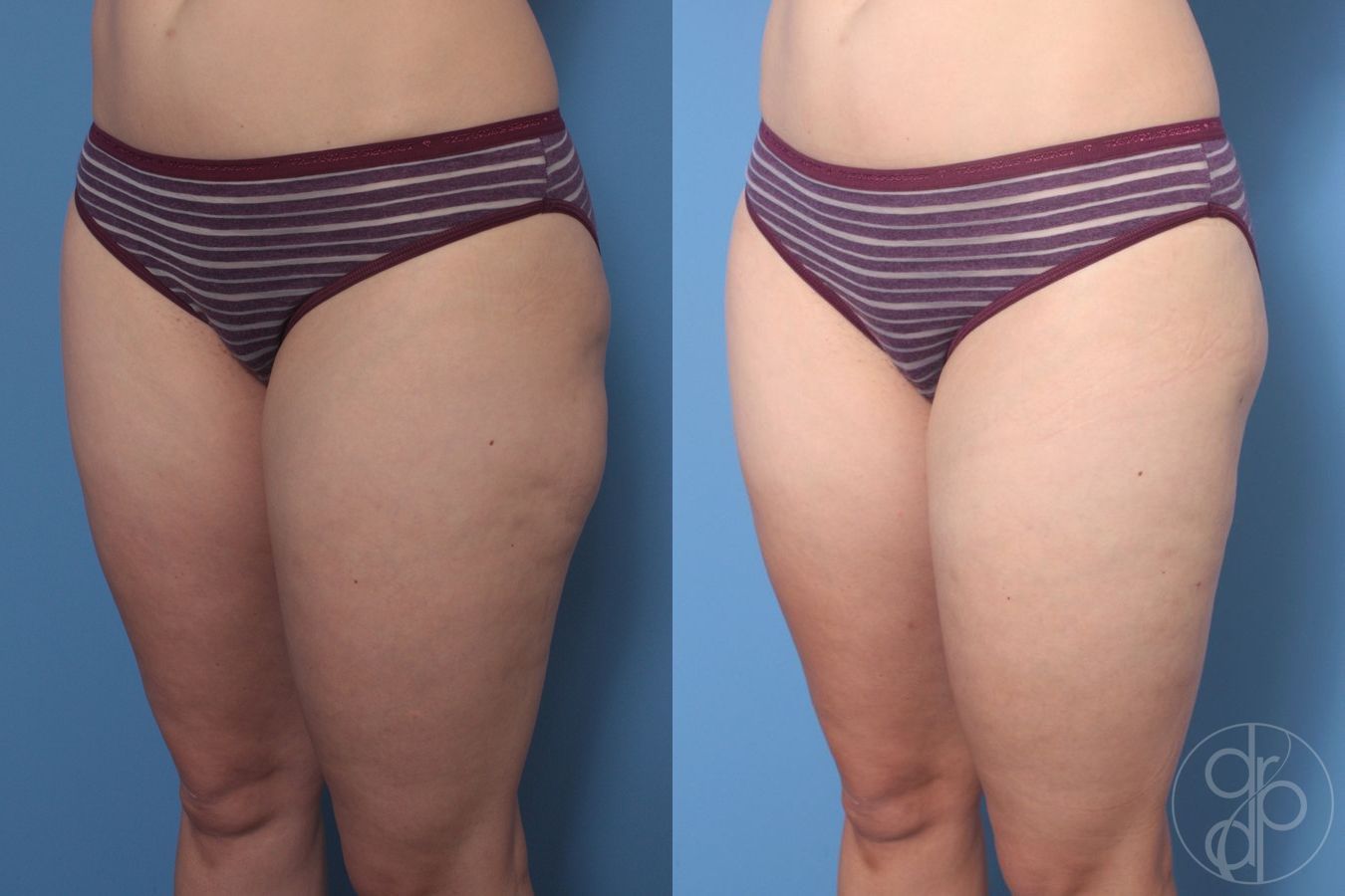 Before and after Liposuction case 29872 - Angle 2