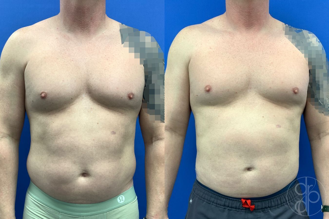 Before and after Liposuction case 41721