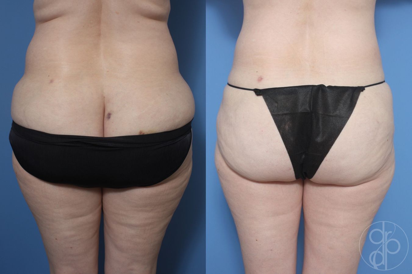 Before and after Liposuction case 29882 - Angle 2