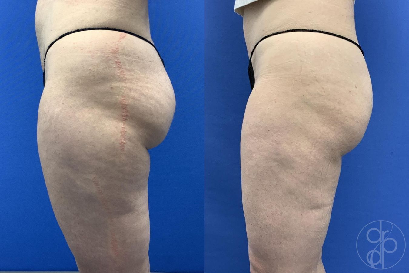 Before and after Liposuction case 30021 - Angle 3