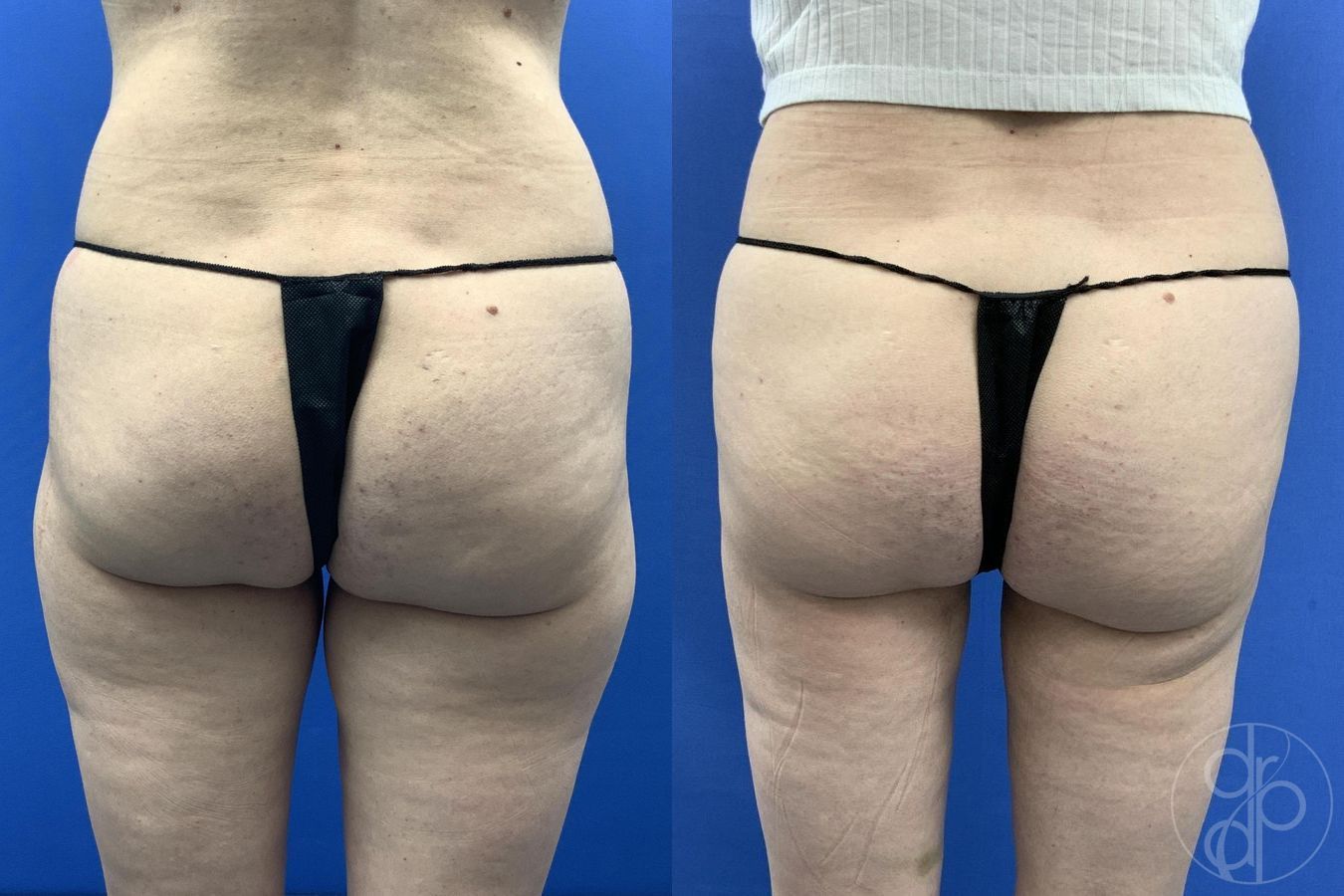 Before and after Liposuction case 30021 - Angle 5