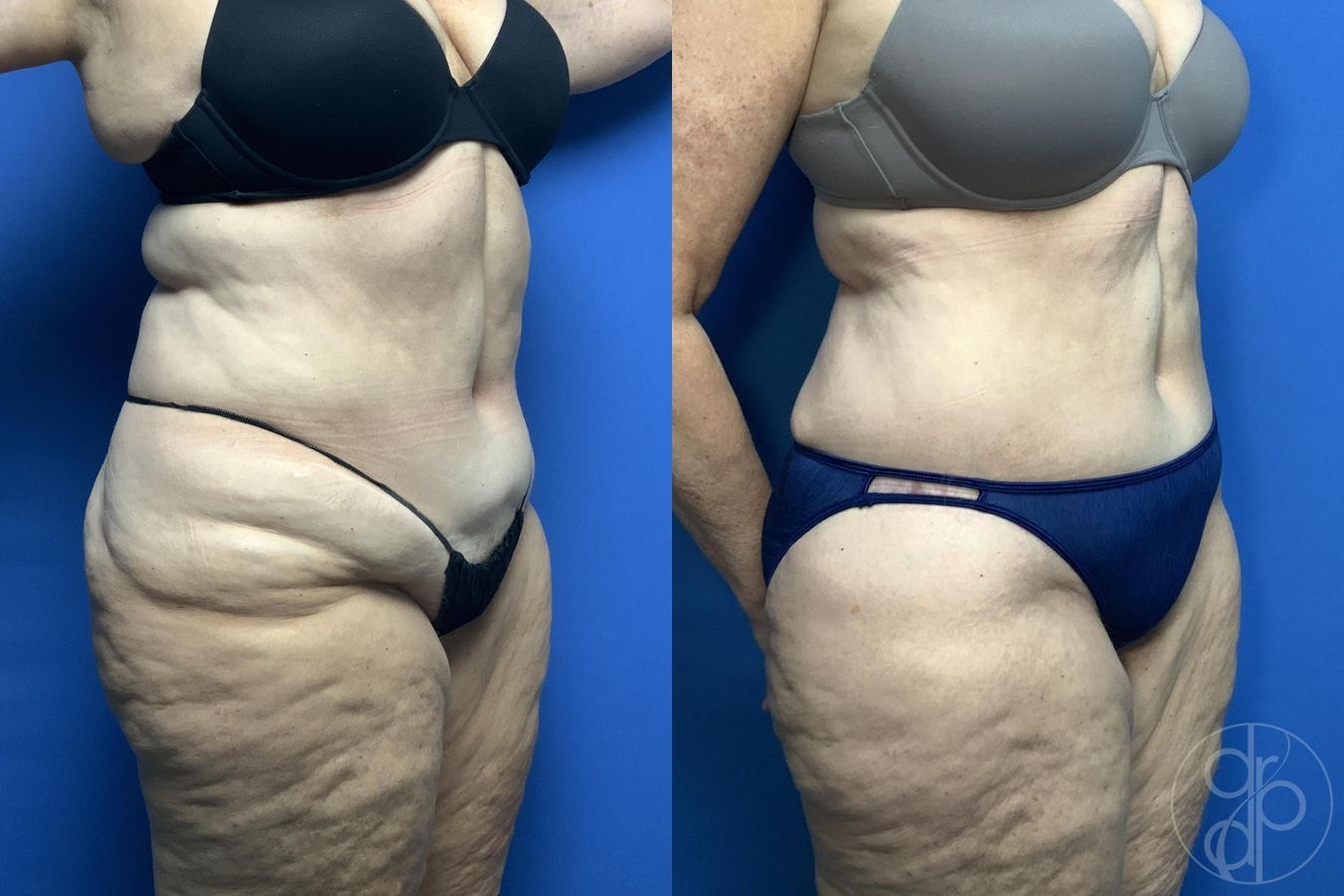 Before and after Liposuction case 30019 - Angle 2