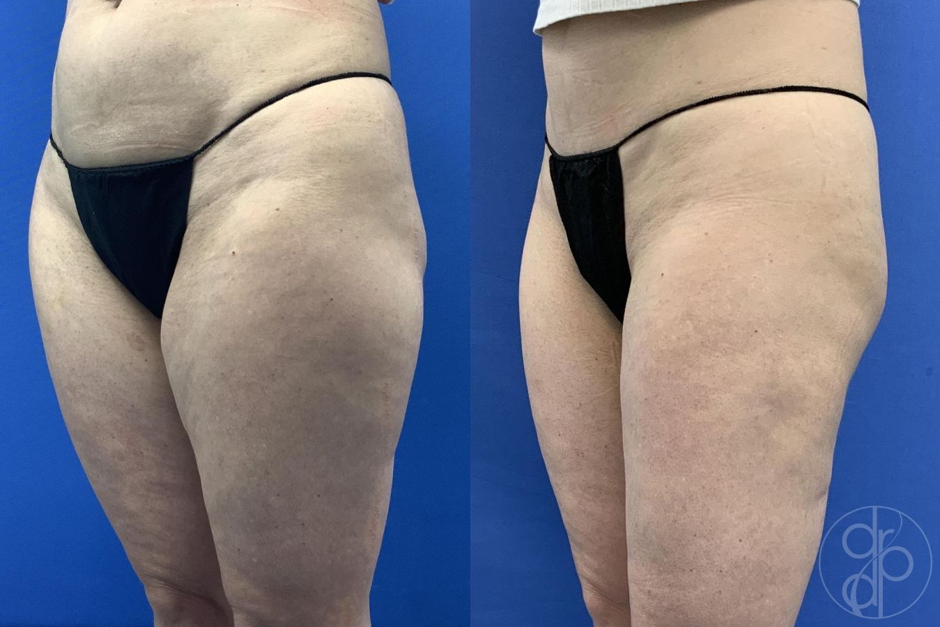 Before and after Liposuction case 30021 - Angle 2