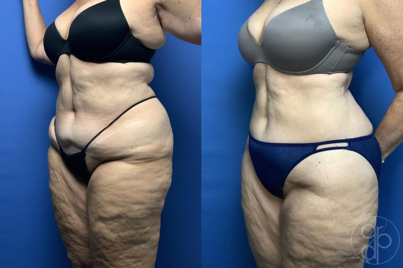 Liposuction - Thumbnail 3