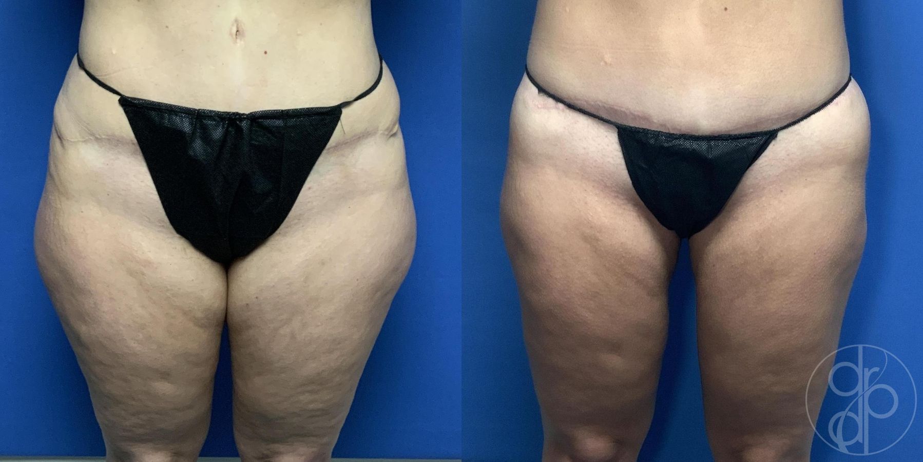 Before and after Liposuction case 29975