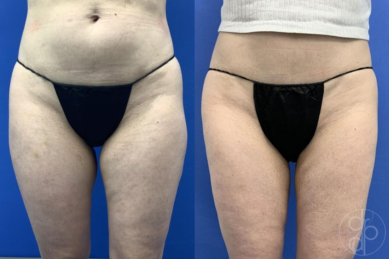 Before and after Liposuction case 30021