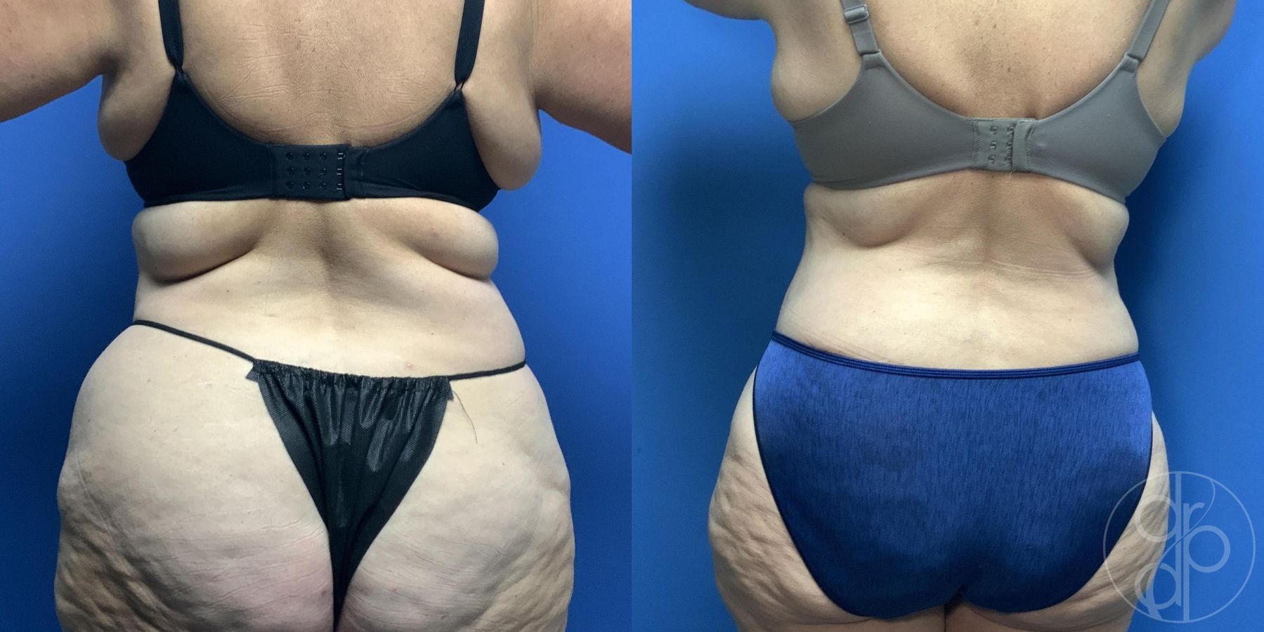 Before and after Liposuction case 30019 - Angle 4