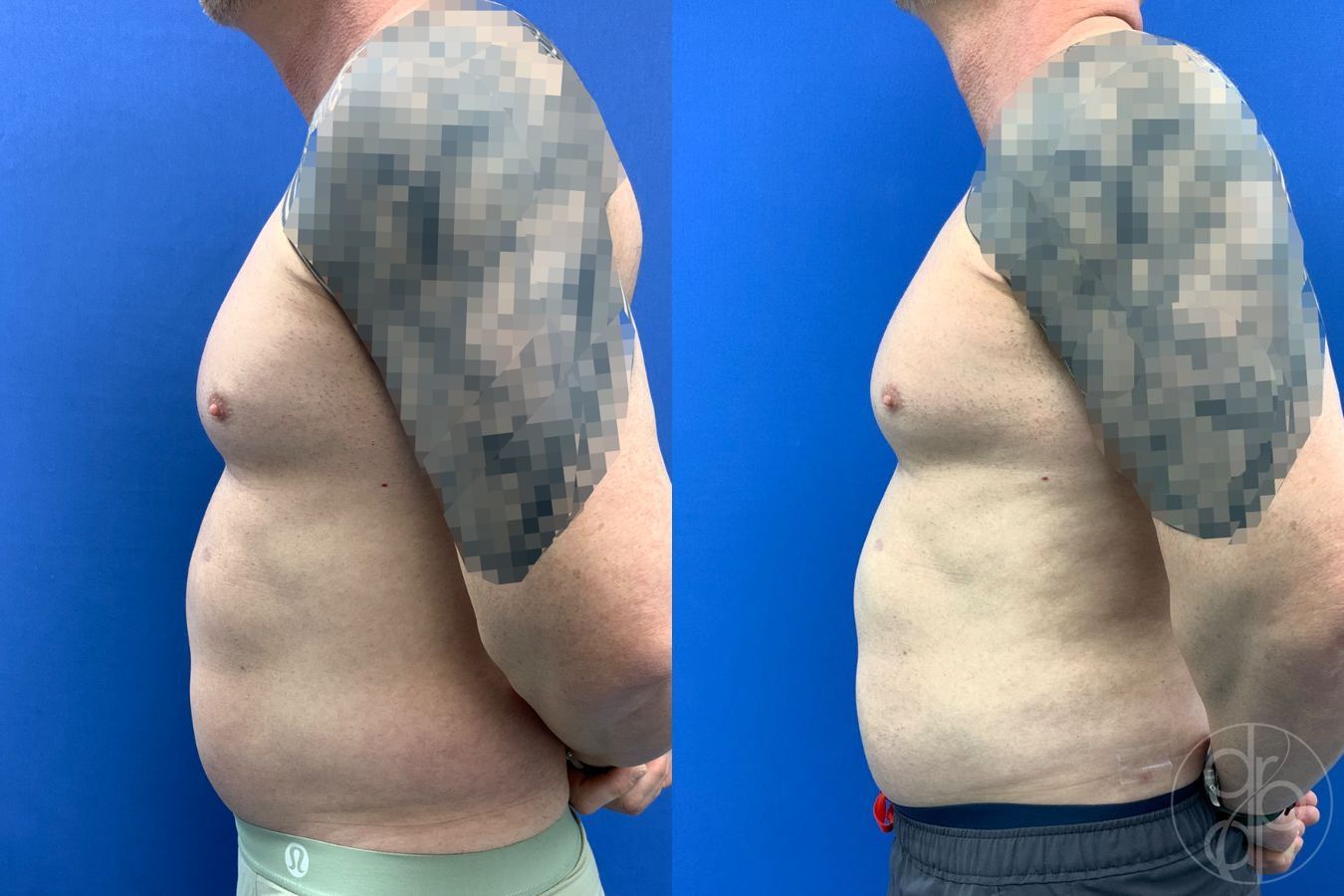 Before and after Liposuction case 41721 - Angle 7