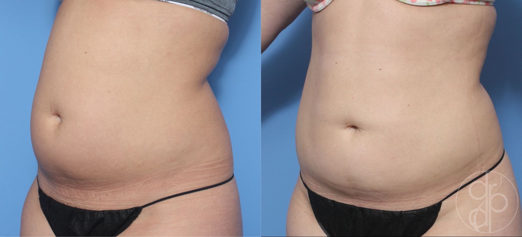 Before and after Liposuction case 29874 - Angle 2