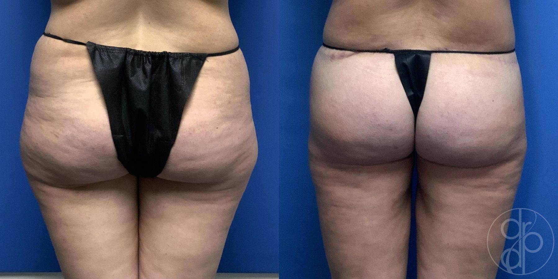 Before and after Liposuction case 29975 - Angle 4