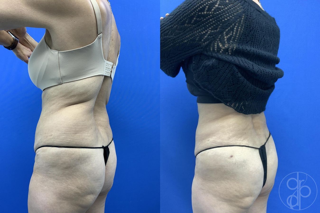 Before and after Liposuction case 29659 - Angle 3
