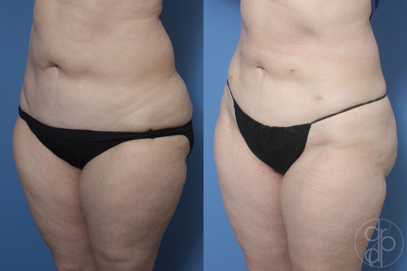 Before and after Liposuction case 29882 - Angle 3