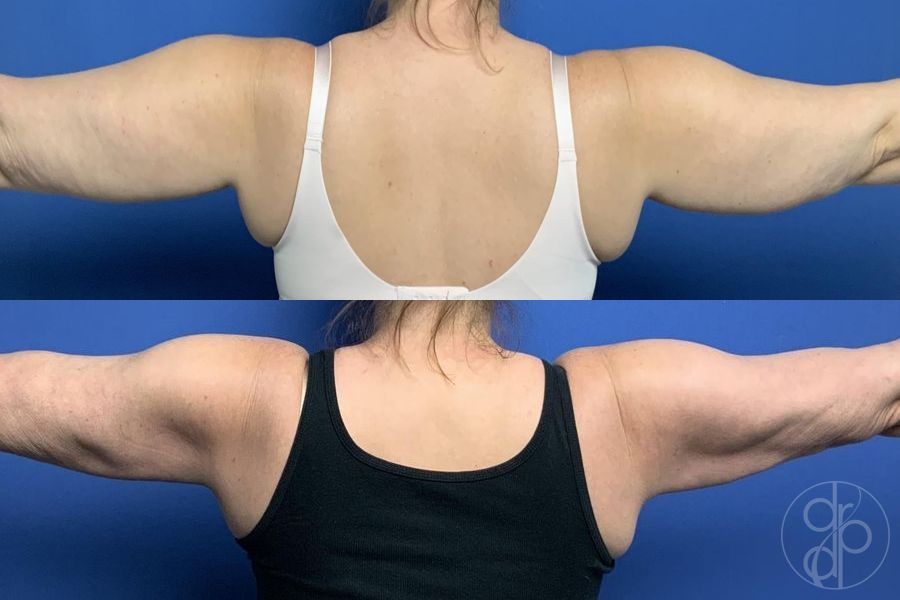 Before and after Liposuction case 29582 - Angle 2