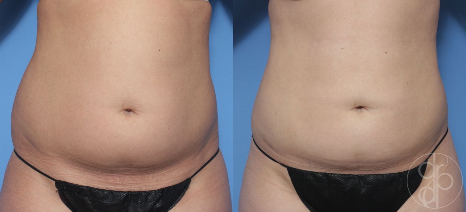 Before and after Liposuction case 29874
