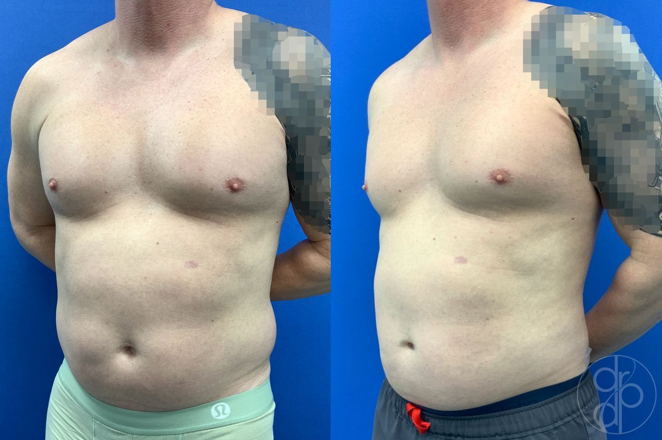 Before and after Liposuction case 41721 - Angle 8