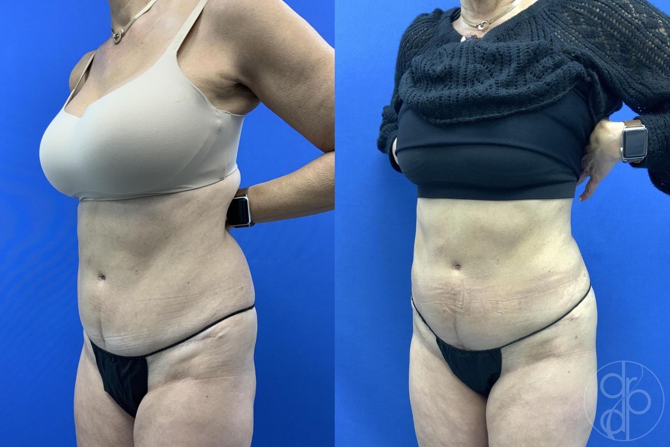 Before and after Liposuction case 29659 - Angle 4