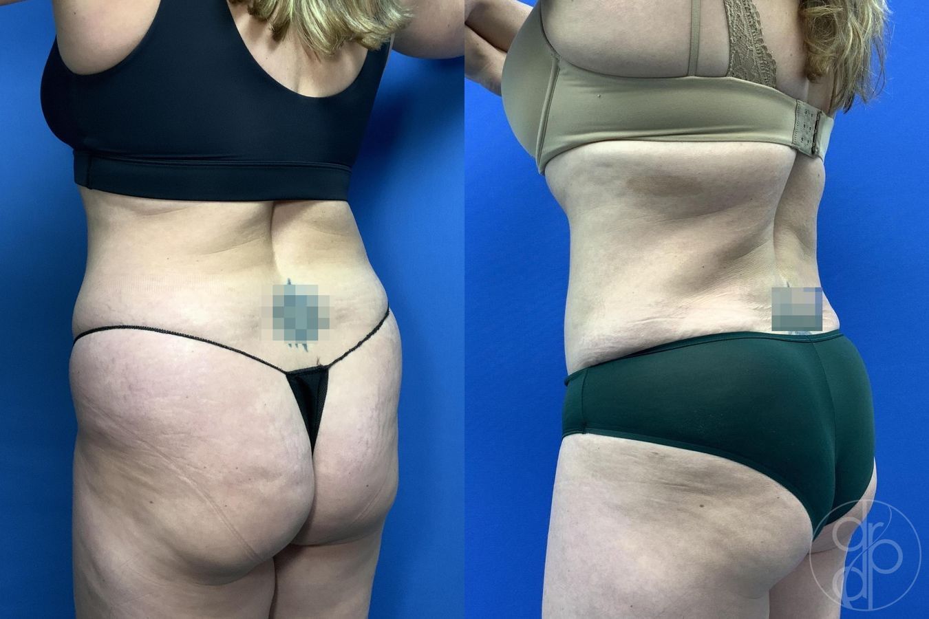 Before and after Liposuction case 30000 - Angle 4