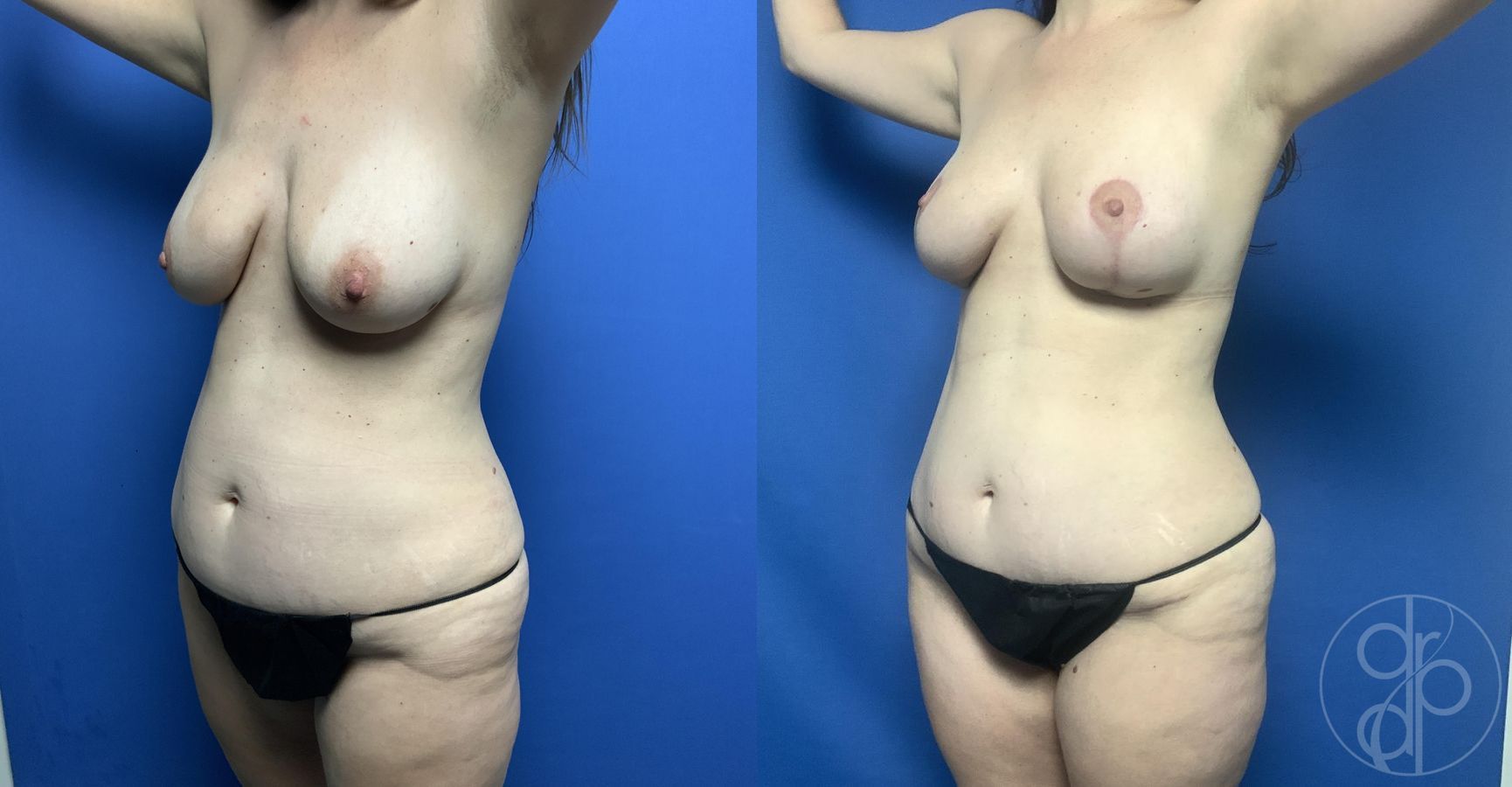 Before and after Mini Tummy Tuck case 29690 - Angle 3