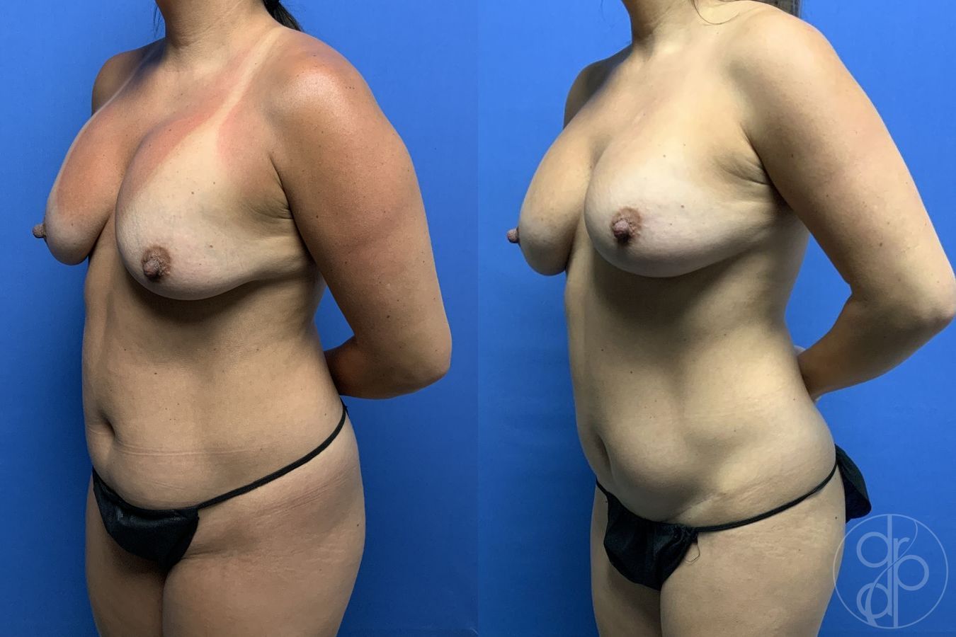 Mini Tummy Tuck - Thumbnail 2