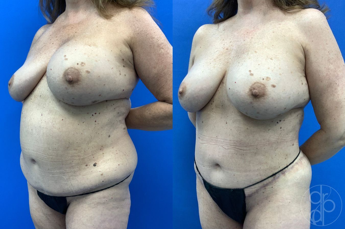 Before and after Mommy Makeover case 46273 - Angle 3