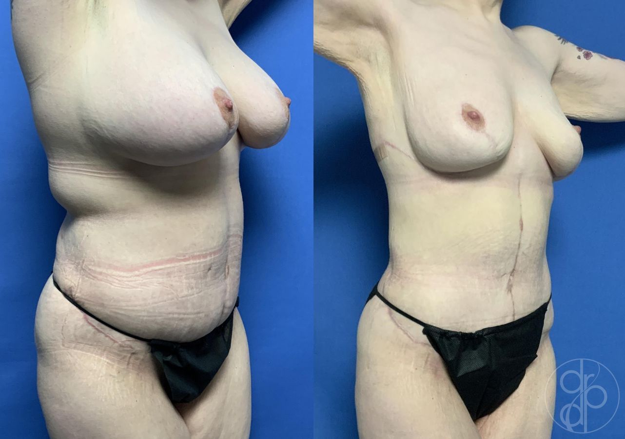 Before and after Mommy Makeover case 29816 - Angle 2