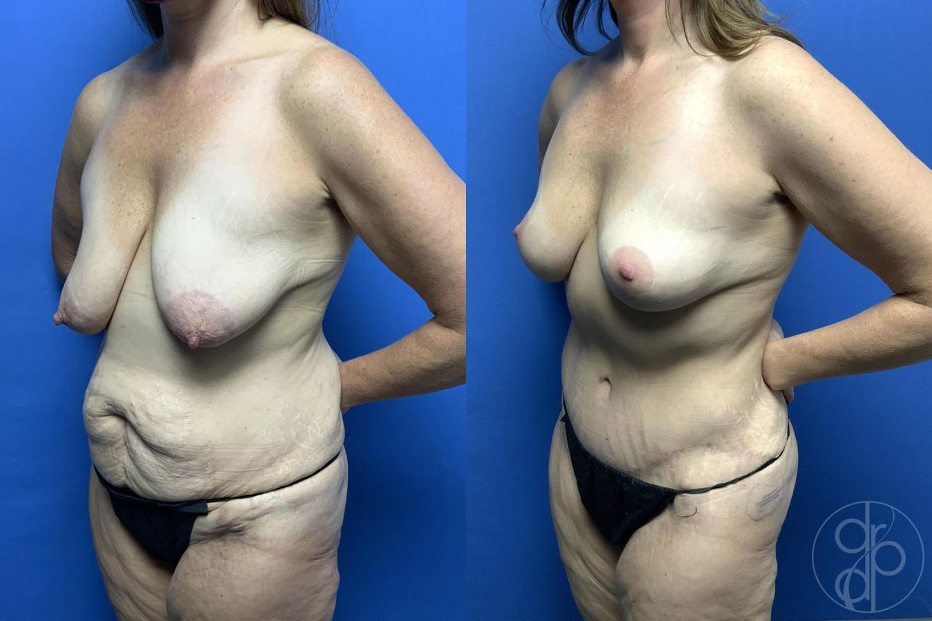 Before and after Mommy Makeover case 29976 - Angle 4