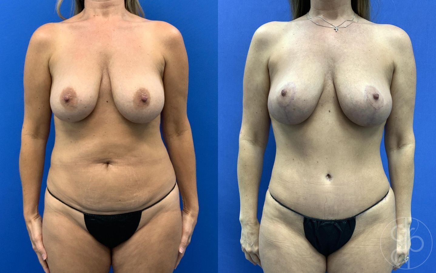 Before and after Mommy Makeover case 29660