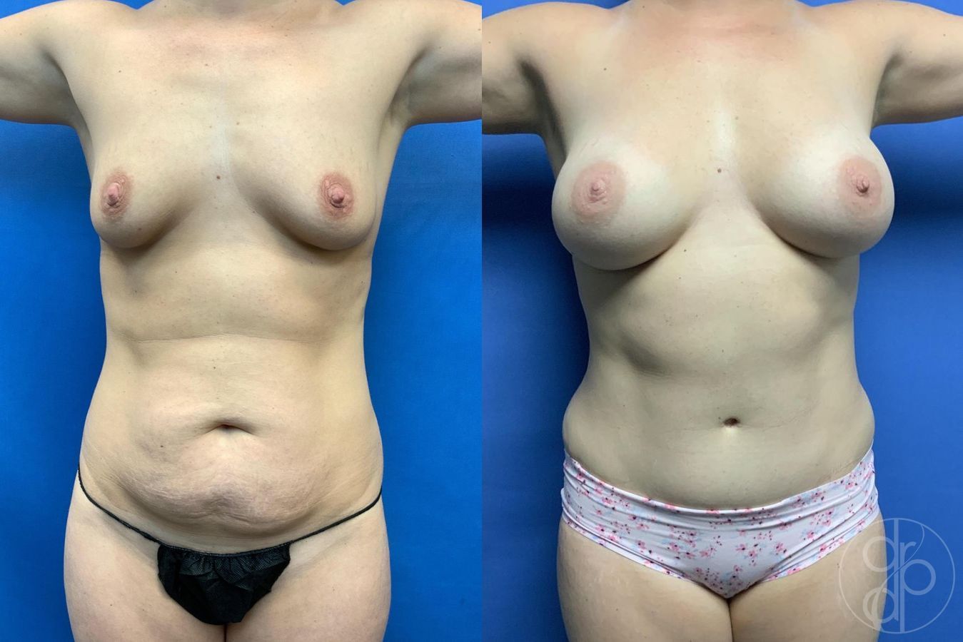 Mommy Makeover - Thumbnail 2