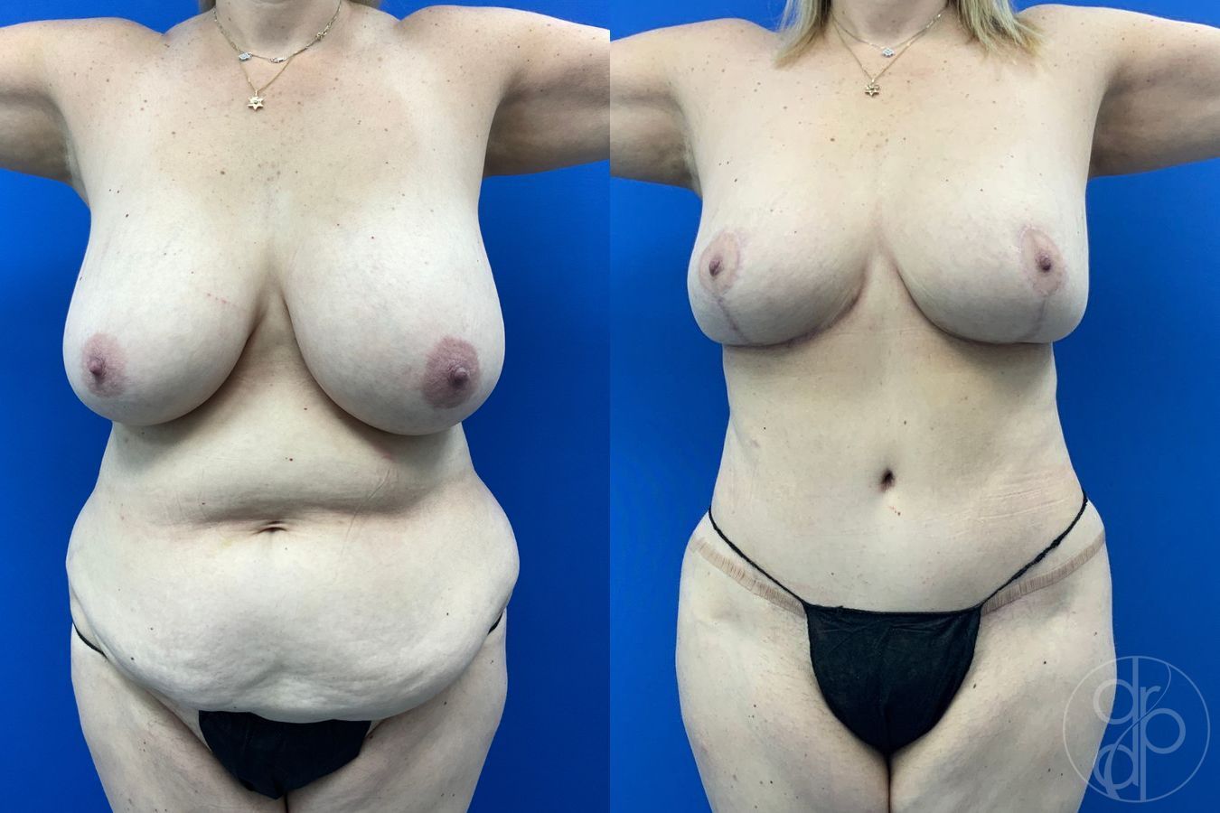 Before and after Abdominoplasty case 46355 - Angle 2