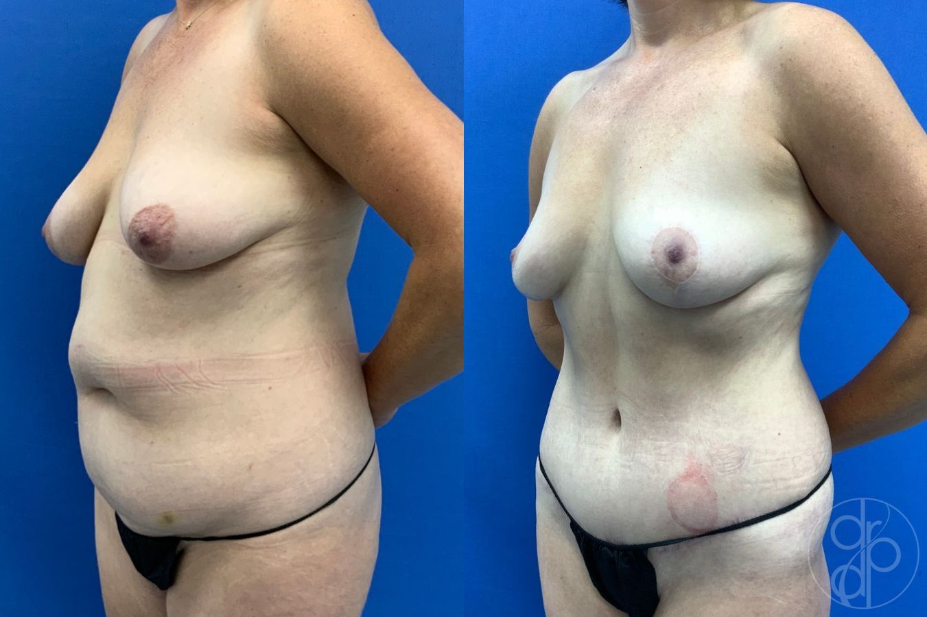 Before and after Mommy Makeover case 46268 - Angle 3