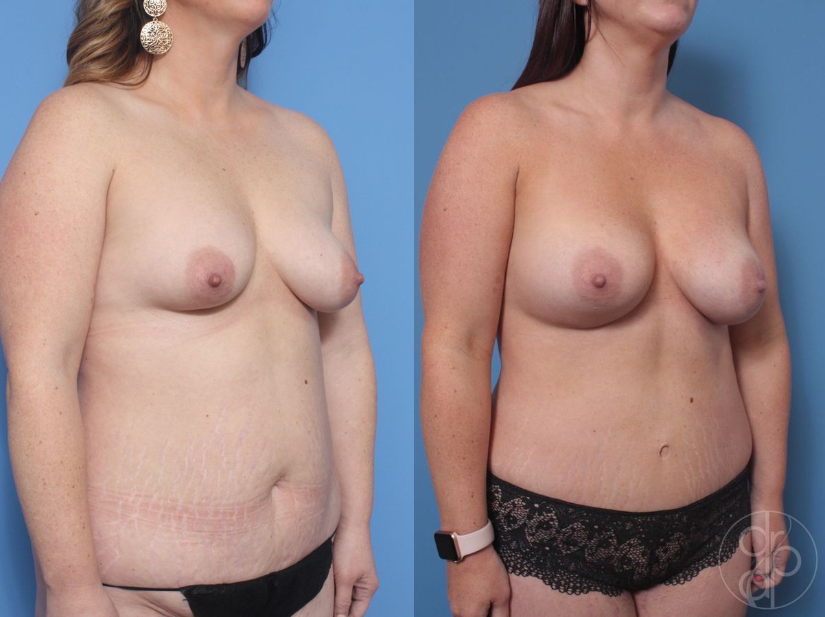 Before and after Mommy Makeover case 29829 - Angle 2
