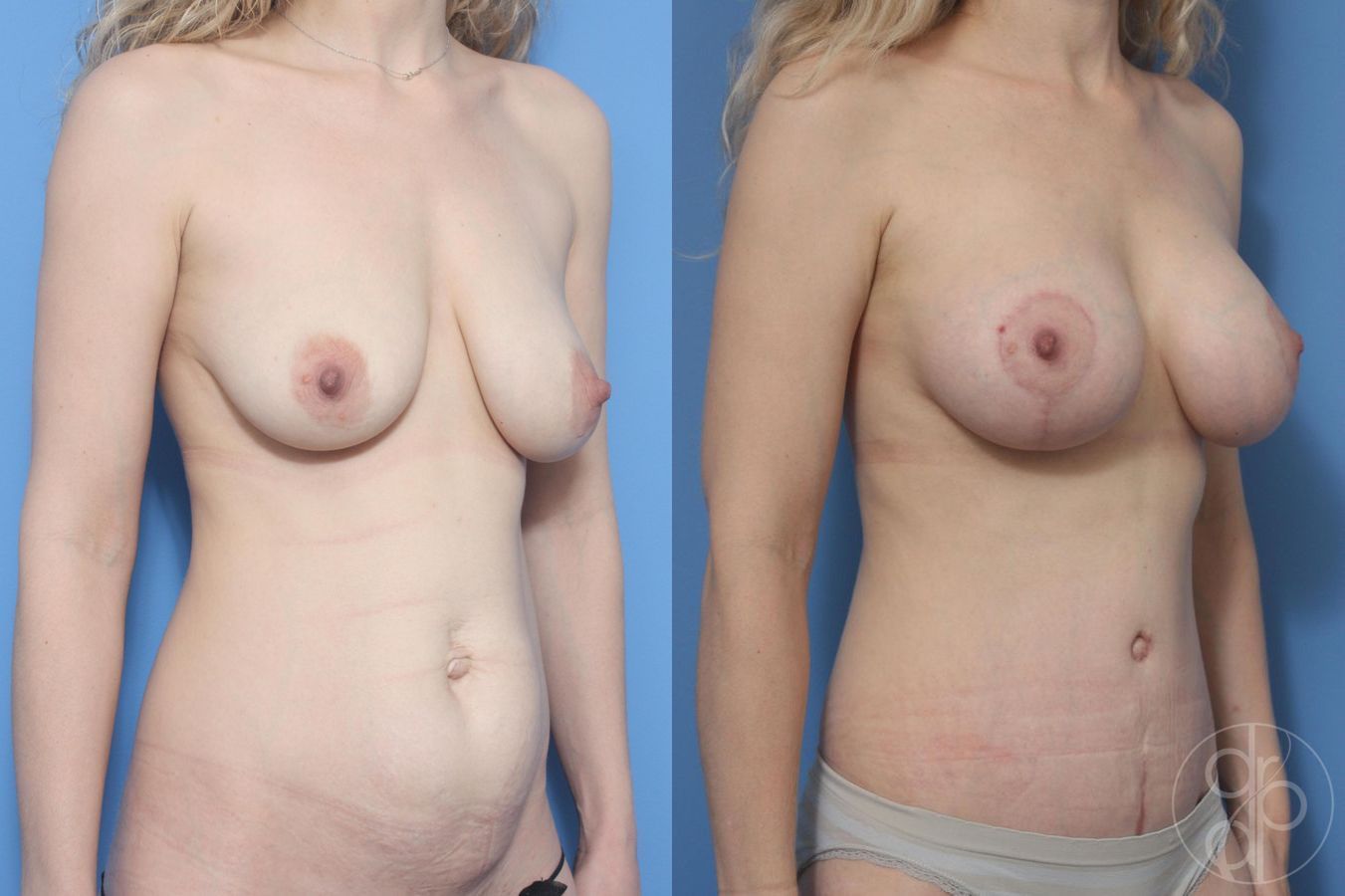 Before and after Tummy Tuck case 29610 - Angle 4