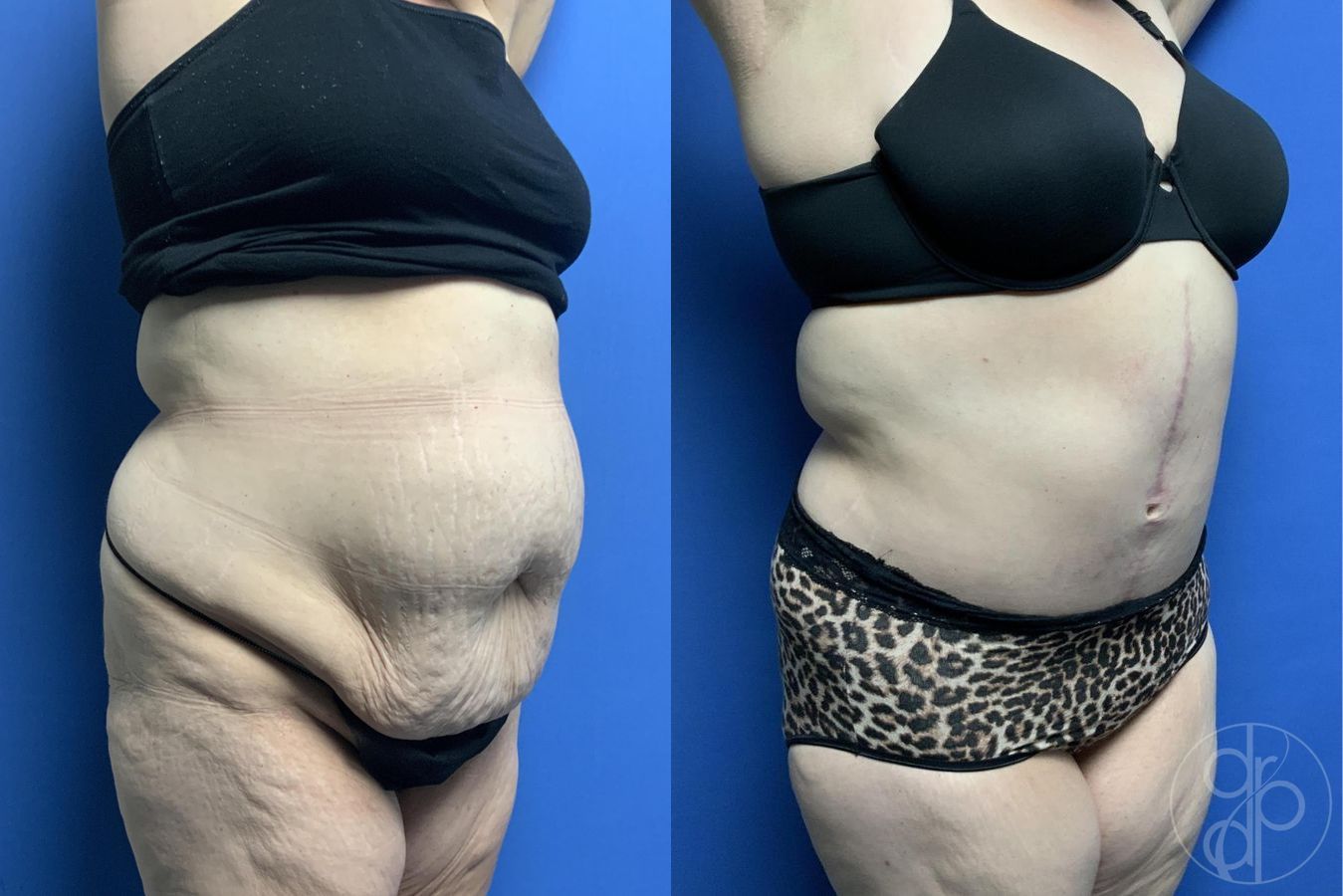 Before and after Mommy Makeover case 29982 - Angle 2