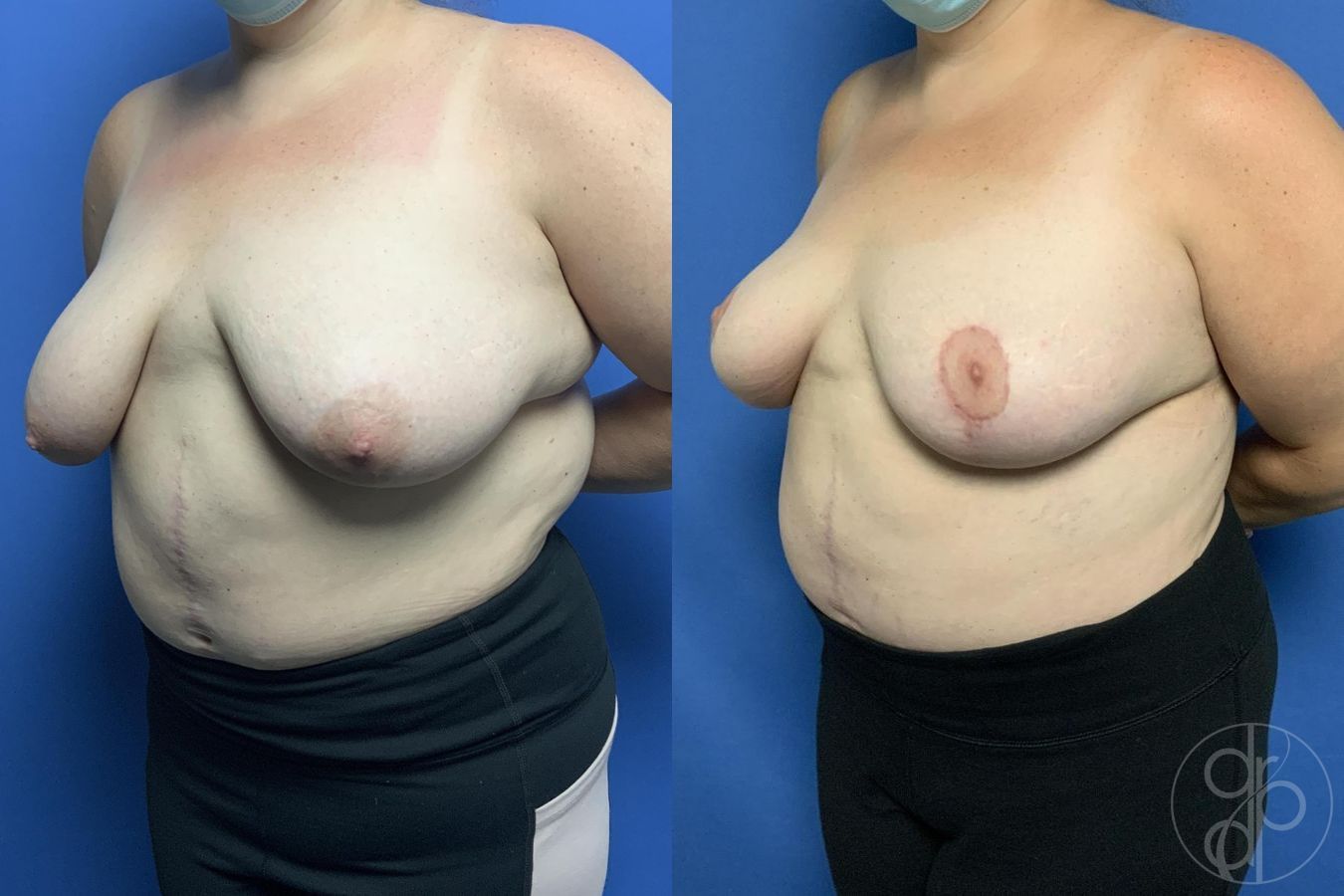 Before and after Mommy Makeover case 29982 - Angle 6