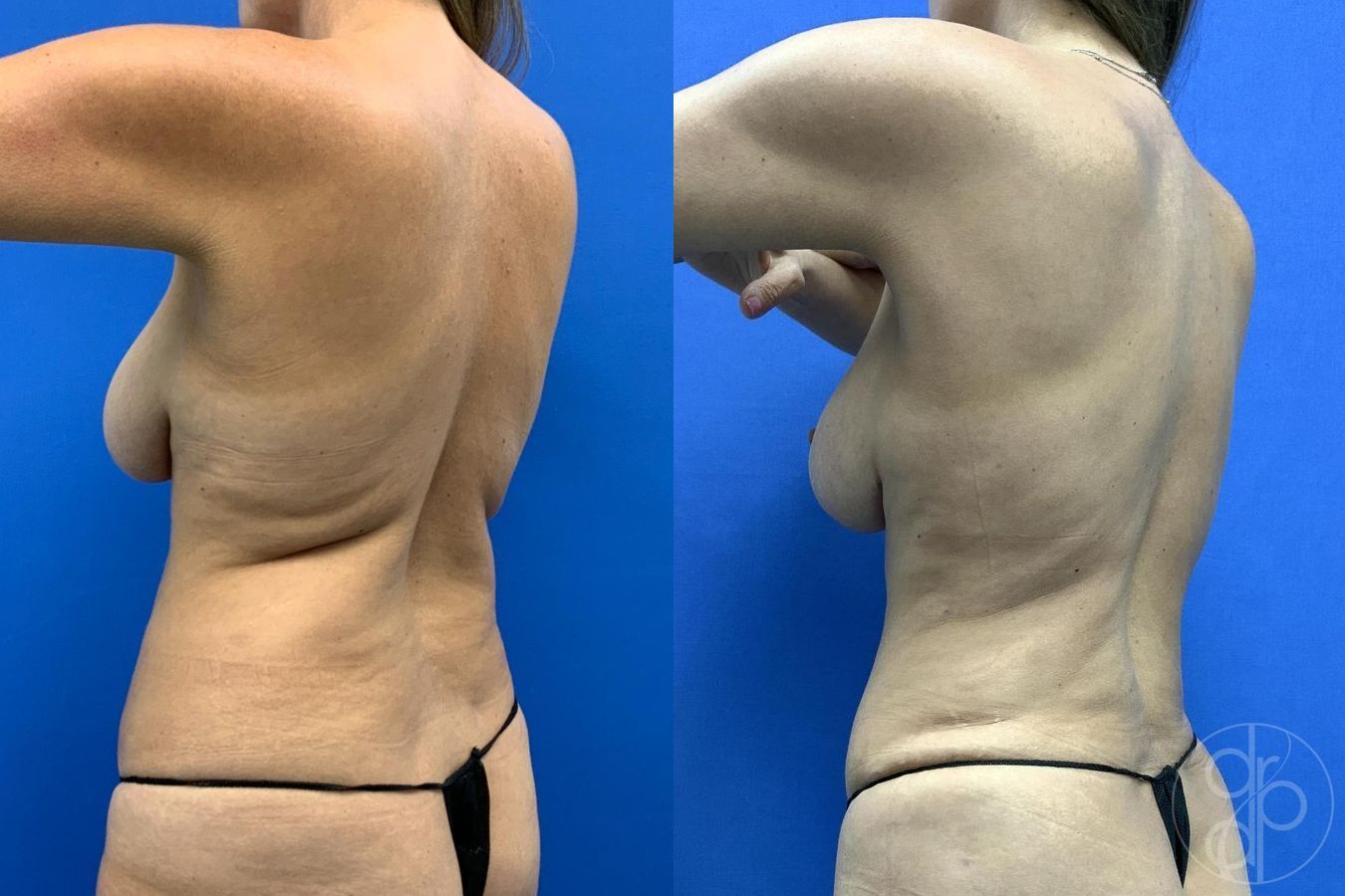 Before and after Mommy Makeover case 29660 - Angle 5