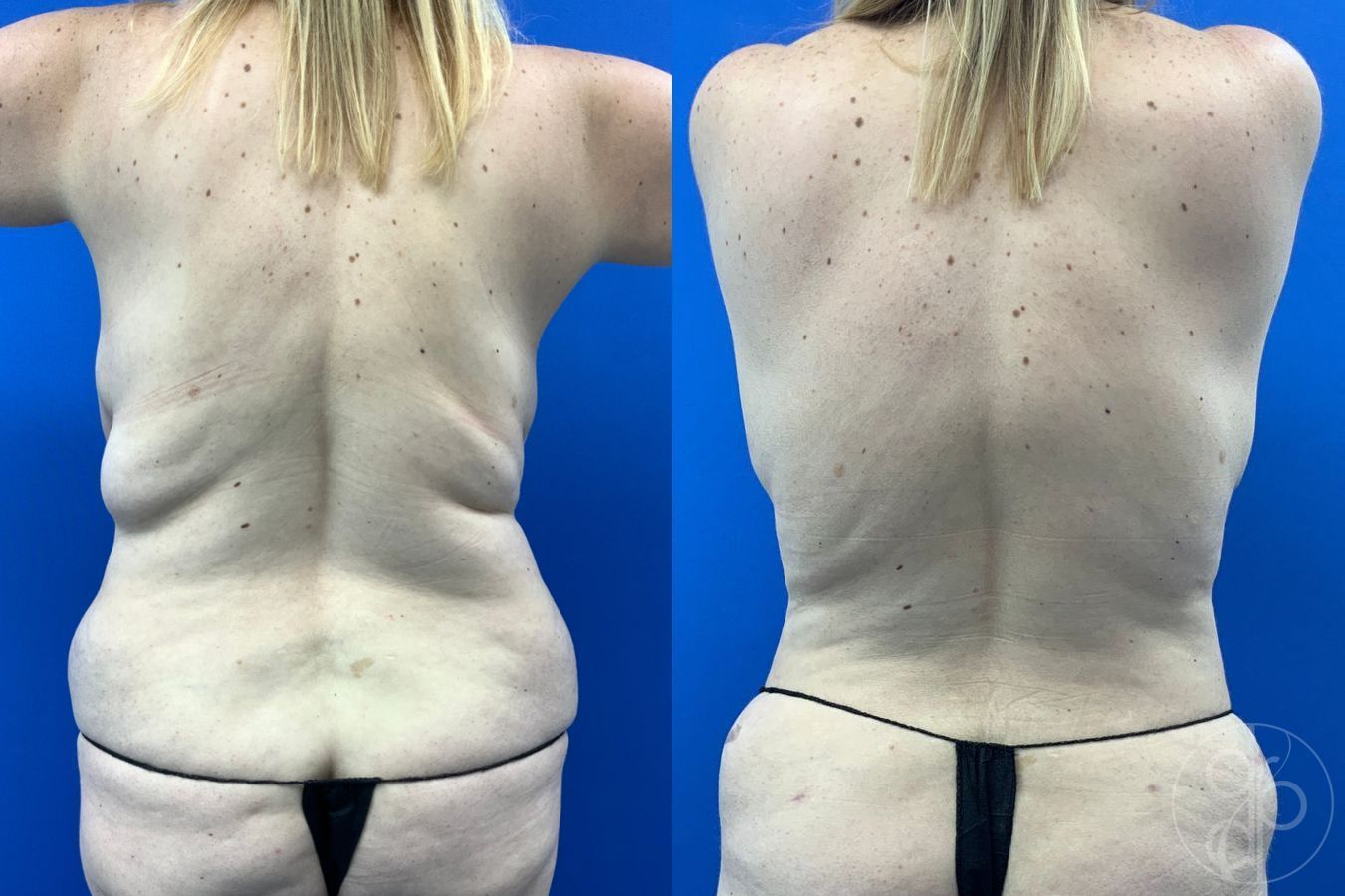 Before and after Abdominoplasty case 46355 - Angle 5