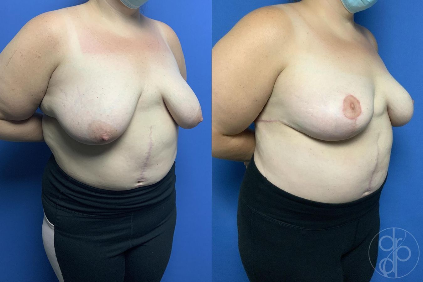 Before and after Mommy Makeover case 29982 - Angle 5