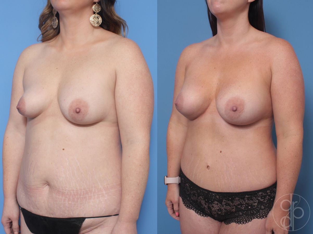 Before and after Mommy Makeover case 29829 - Angle 3