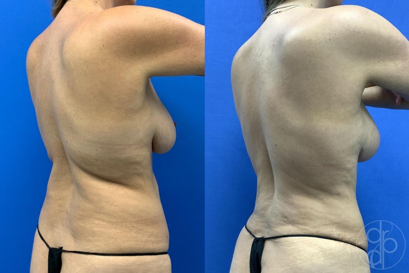 Before and after Mommy Makeover case 29660 - Angle 6
