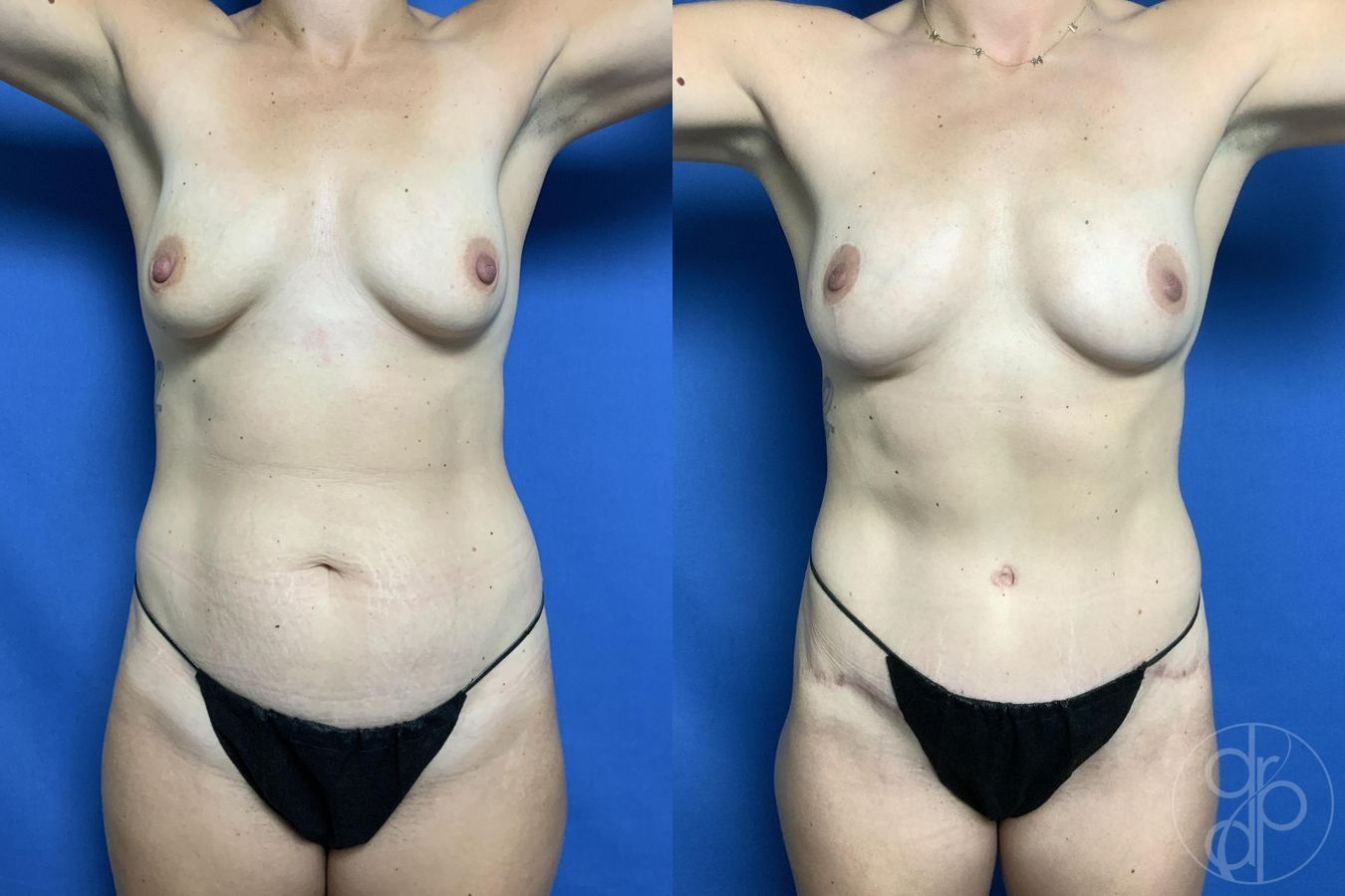 Before and after Mommy Makeover case 29978 - Angle 2