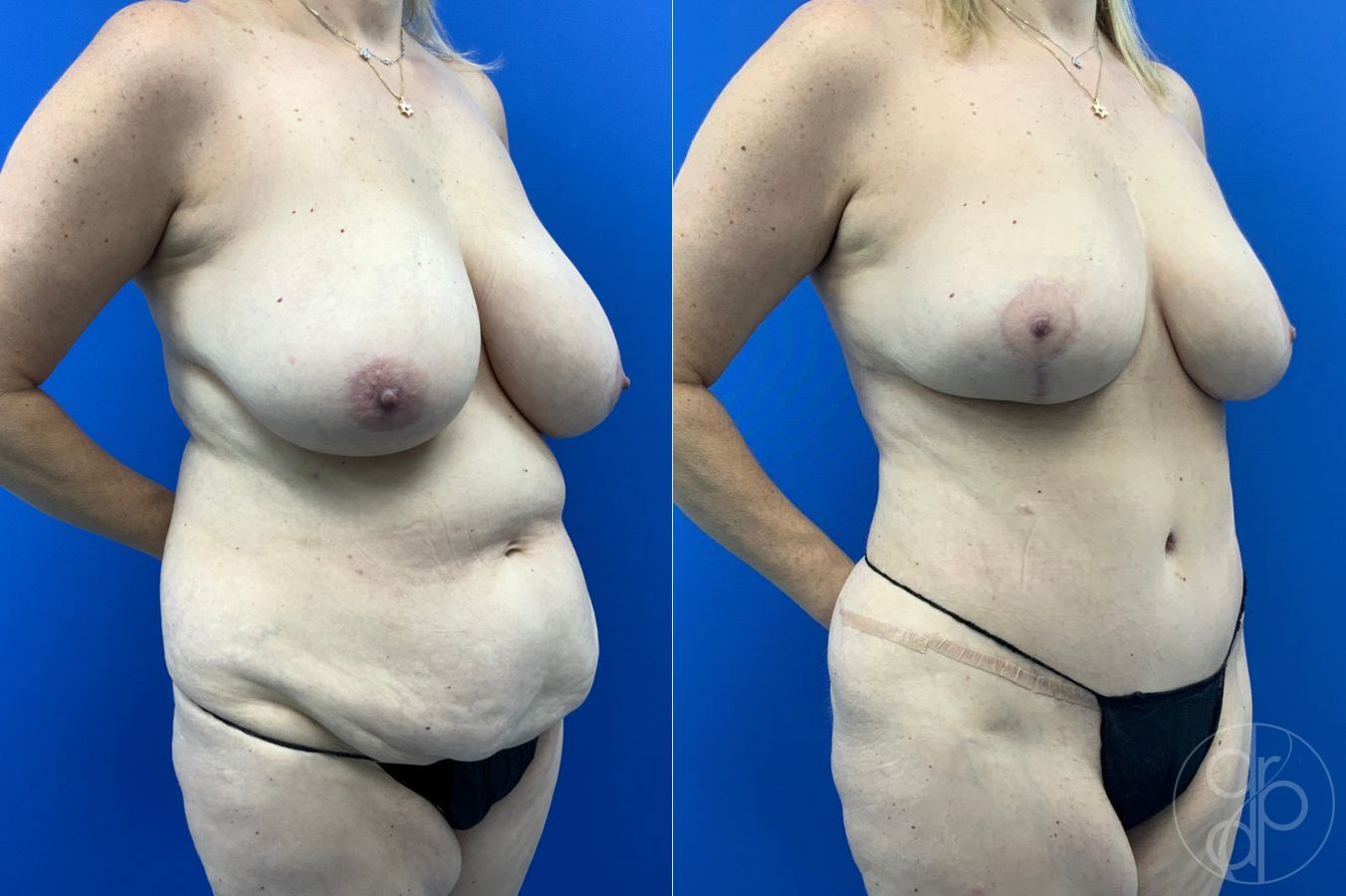 Before and after Abdominoplasty case 46355 - Angle 7
