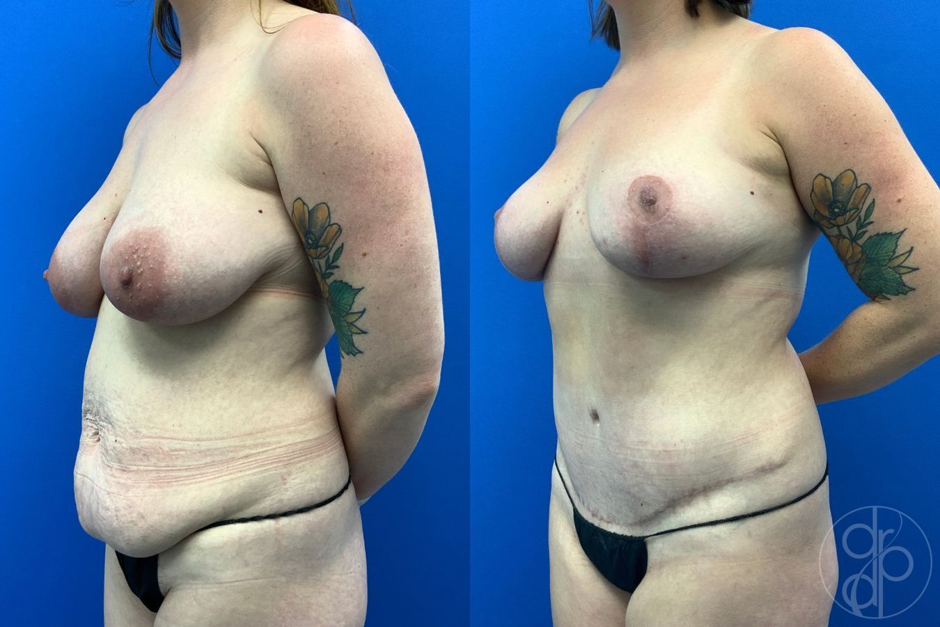 Before and after Mommy Makeover case 43477 - Angle 3