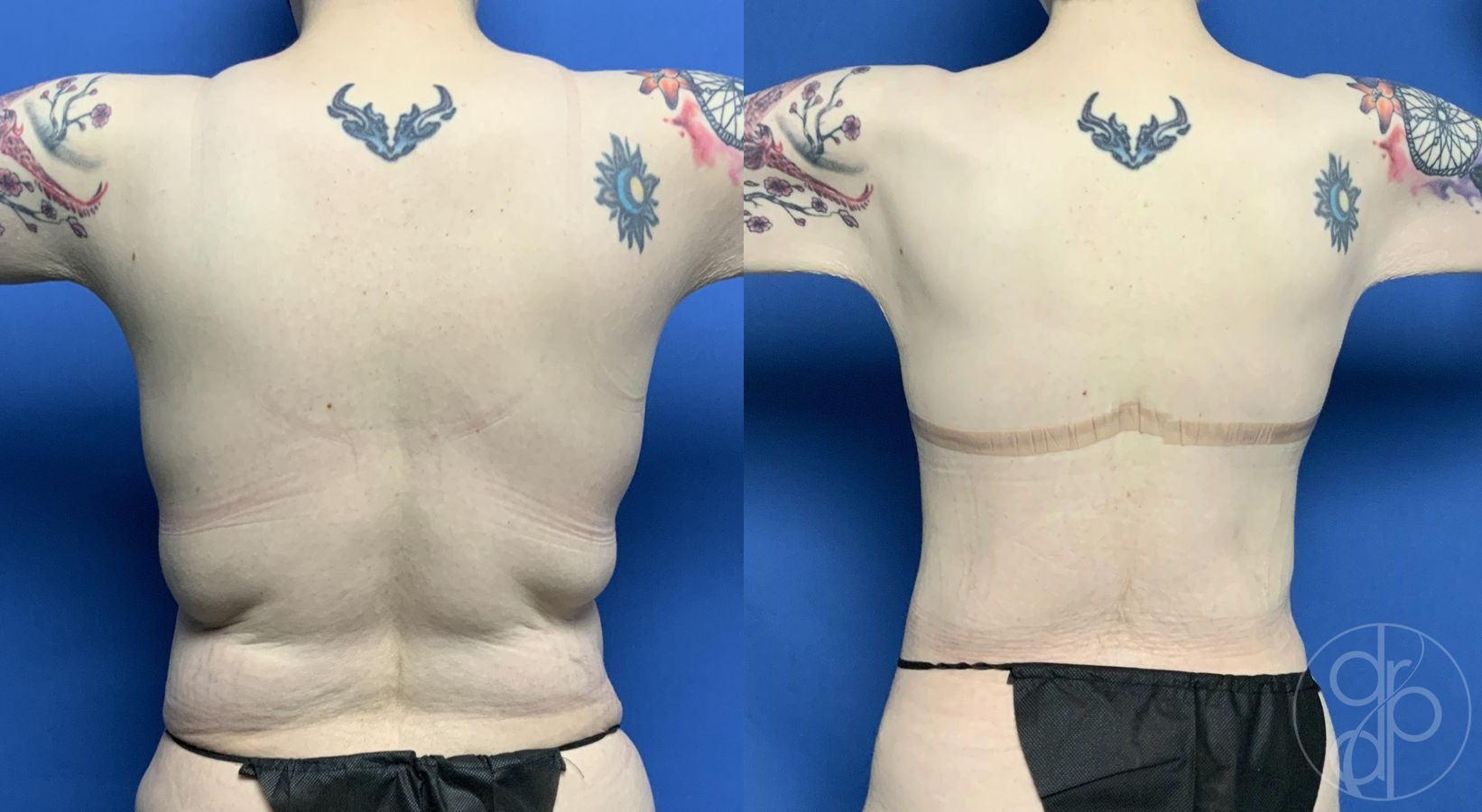 Before and after Mommy Makeover case 29816 - Angle 4