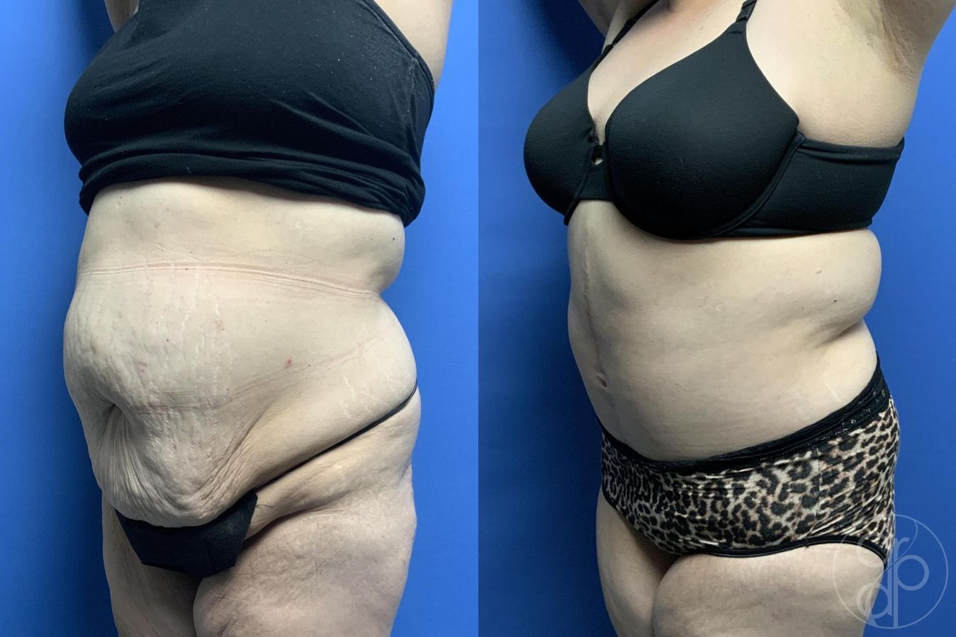 Before and after Mommy Makeover case 29982 - Angle 3