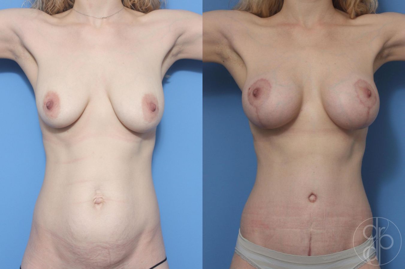 Before and after Tummy Tuck case 29610 - Angle 2