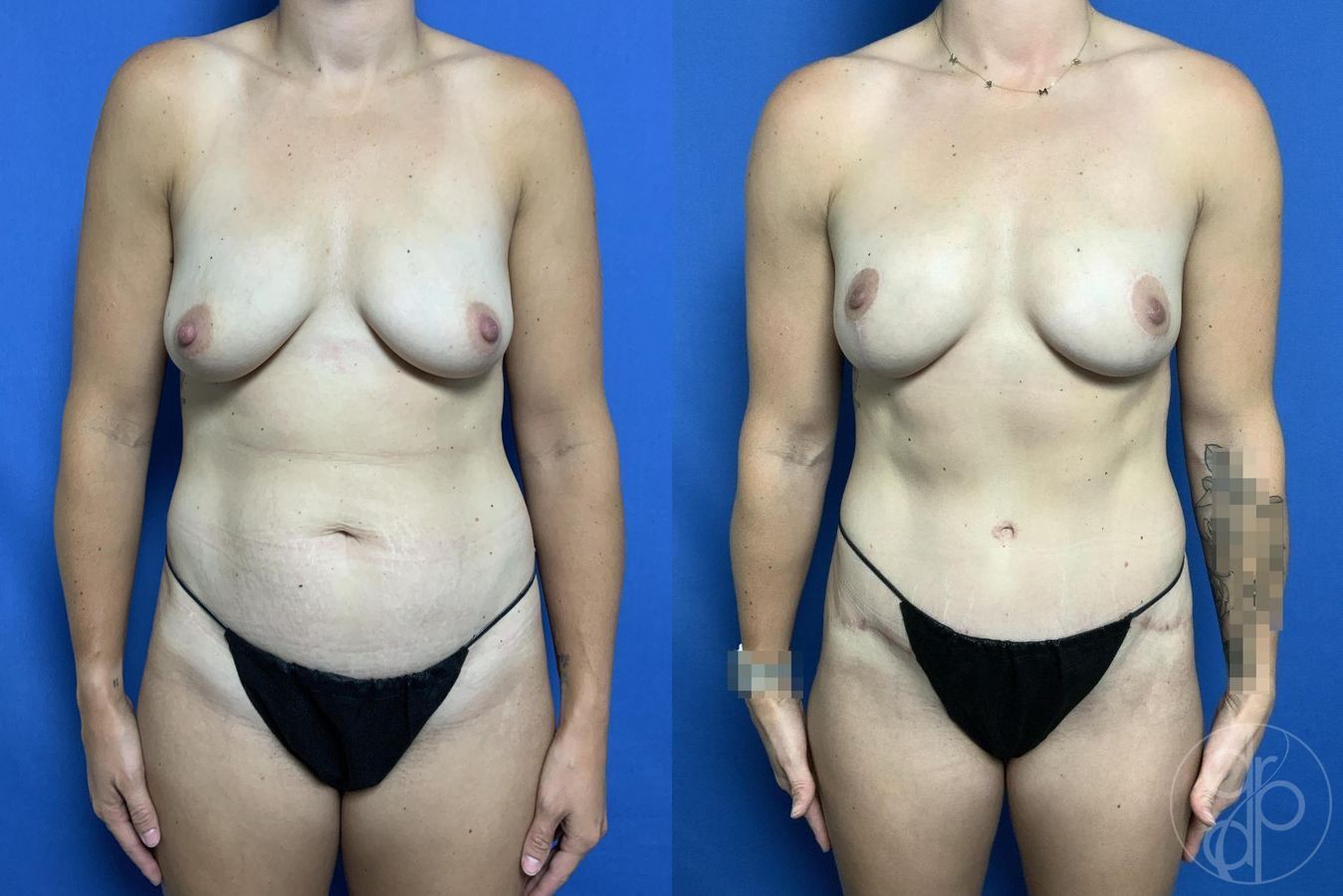 Before and after Mommy Makeover case 29978